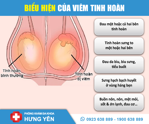 3 địa chỉ chữa bệnh viêm tinh hoán tốt nhất ở Hưng Yên 2024