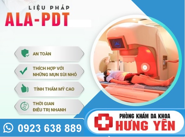 Tư vấn khám chữa sùi mào gà ở Hưng Yên – Bệnh xã hội