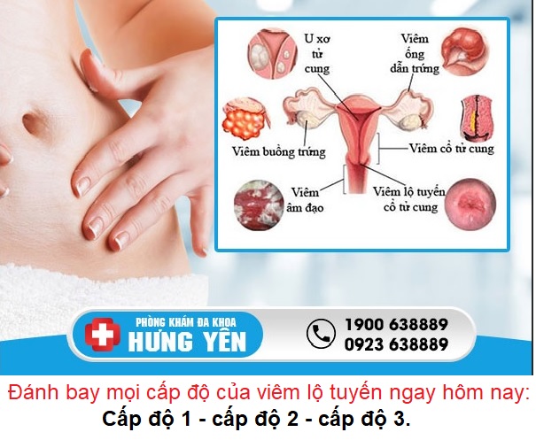 chua-benh-viem-lo-tuyen-co-tu-cung-o-hung-yen