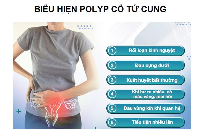 polyp co tu cung