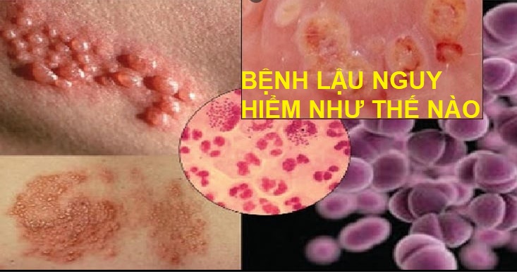Top 3 nơi khám và điều trị bệnh lậu lớn ở Hưng Yên
