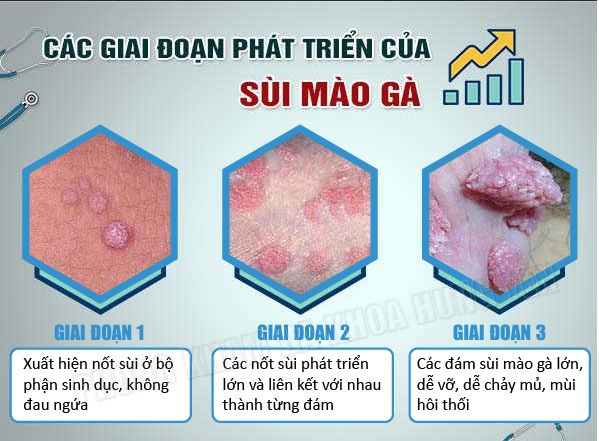 Phòng khám nào ở Hưng Yên khám sùi mào gà chính xác nhất