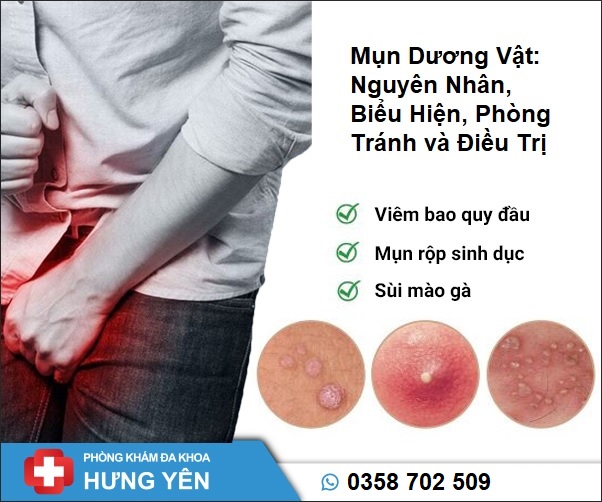 Mụn Dương Vật: Nguyên Nhân, Biểu Hiện, Điều Trị