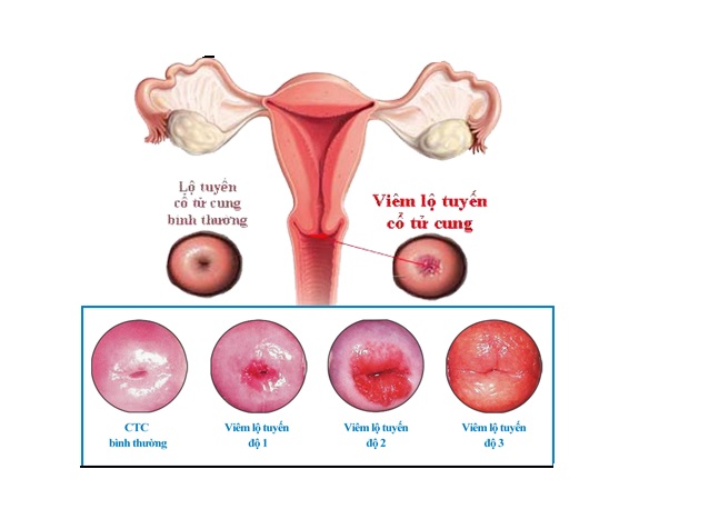Khám Bệnh Viêm Lộ Tuyến Cổ Tử Cung Ở Hưng Yên